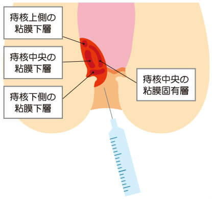 内痔核に効果的なジオン注射対応 品川区 目黒区痔の日帰り手術navi